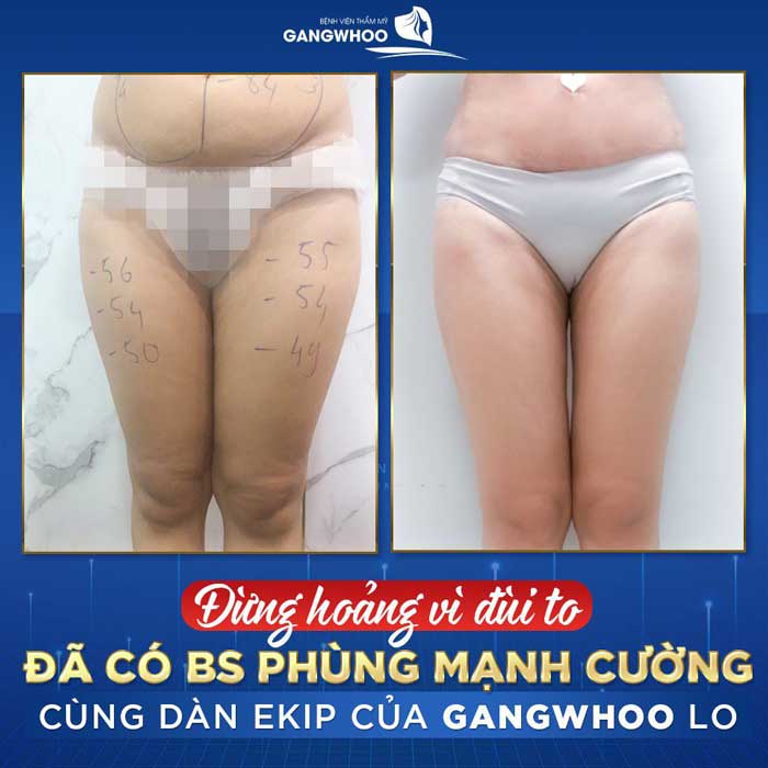 Hình ảnh thực tế khách hàng giảm mỡ đùi tại bệnh viện Gangwhoo