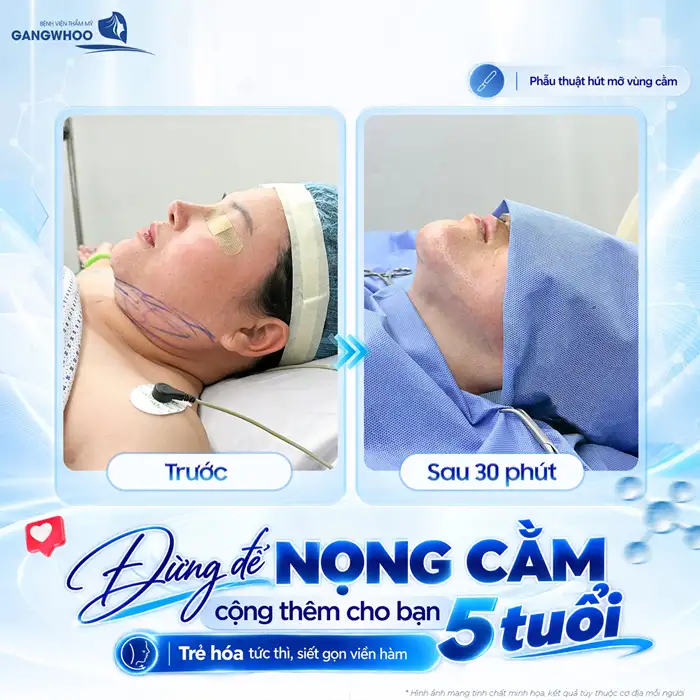 Hút Mỡ Nọng Cằm An Toàn Hiệu Quả Bệnh Viện Gangwhoo