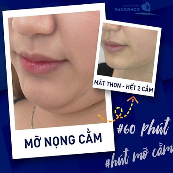 Hình ảnh thực tế Chị Oanh giảm mỡ nọng cằm thành công tại bệnh viện Gangwhoo