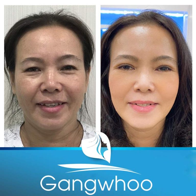Hình ảnh thực tế hút mỡ má Cô Thúy tại bệnh viện Gangwhoo