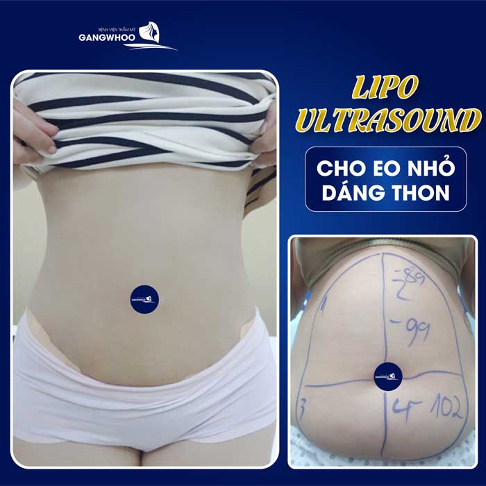 khách hàng giảm mỡ bụng bằng công nghệ Lipo Ultrasound tại bệnh viện Gangwhoo