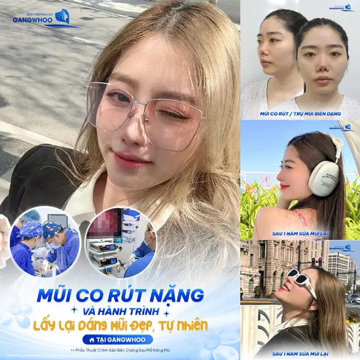 Nâng Mũi Sụn Sườn Sinh Học – Công Nghệ Nâng Mũi hàng đầu hiện nay