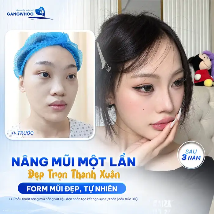Nâng Mũi Perfect – Giải Pháp Cho Dáng Mũi
