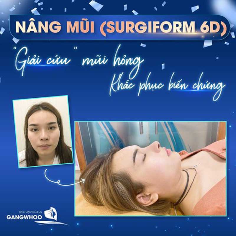 Hình ảnh thực tế Chị Ngọc Anh nâng mũi Surgiform 6D