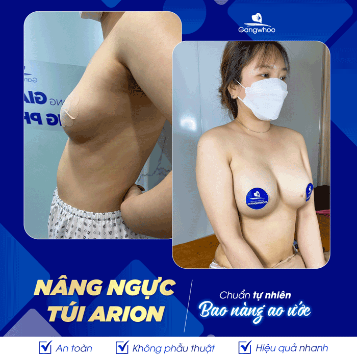 Hình ảnh thực tế khách hàng nâng ngực túi Arion tại bệnh viện Gangwhoo