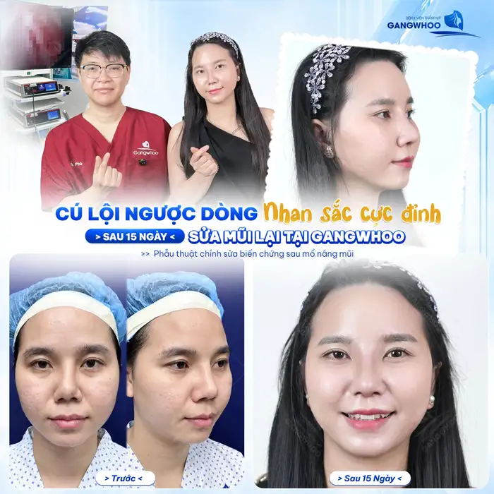 Sửa Mũi Hỏng – An Toàn, Hiệu Quả tại bệnh Viện Gangwhoo