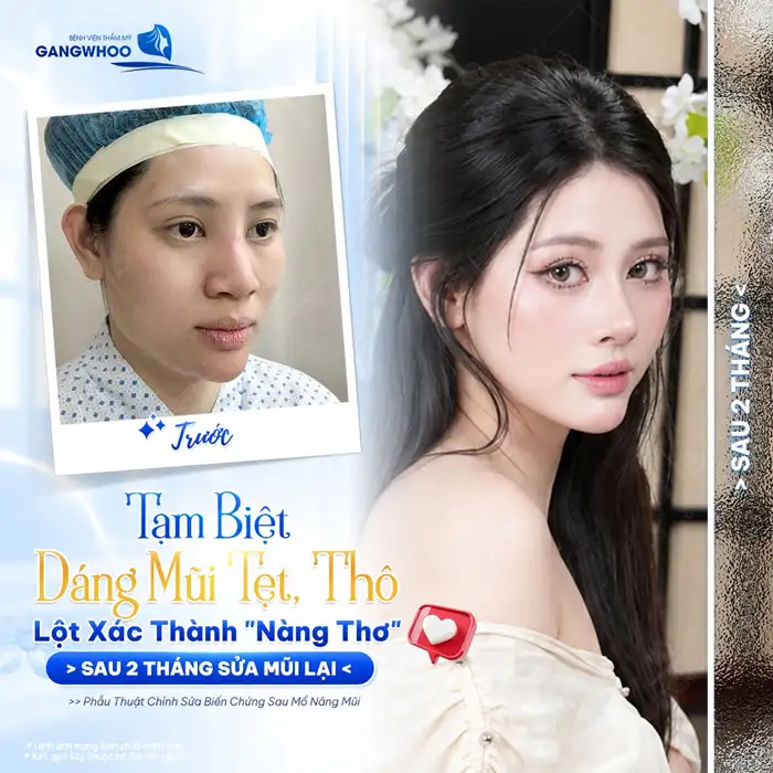 Sửa Mũi Hỏng – An Toàn, Hiệu Quả tại bệnh Viện Gangwhoo