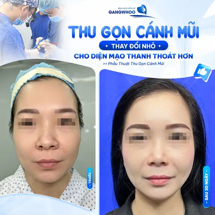 Thu Gọn Cánh Mũi