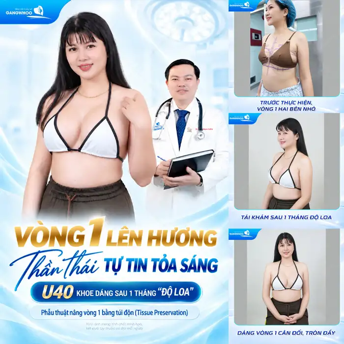 Nâng Ngực Túi Arion Vi Nhám – Chuẩn Hàn Tại Việt Nam