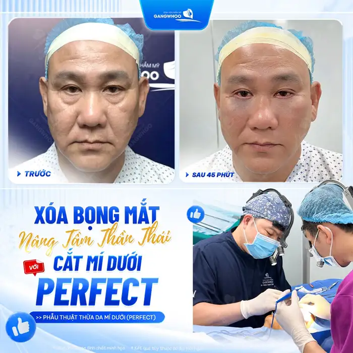 Cắt Mí mắt Perfect giải pháp cho 2 mí đẹp chuẩn tự nhiên