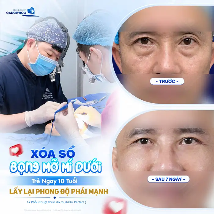 Cắt Mí mắt Perfect giải pháp cho 2 mí đẹp chuẩn tự nhiên
