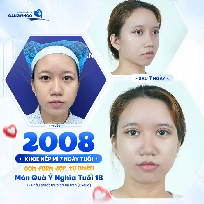CẮT MÍ MẮT (EYELID) TỰ TIN THU HÚT MỌI ÁNH NHÌN – HOÀN THIỆN CỬA SỔ TÂM HỒN