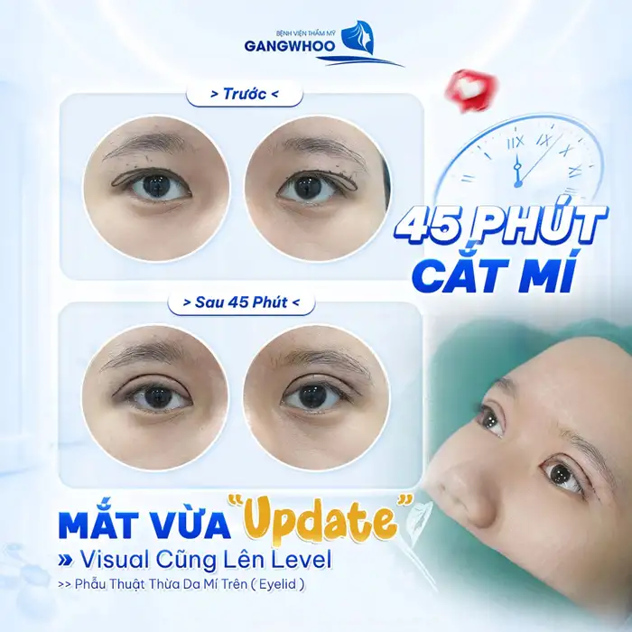 CẮT MÍ MẮT (EYELID) TỰ TIN THU HÚT MỌI ÁNH NHÌN – HOÀN THIỆN CỬA SỔ TÂM HỒN