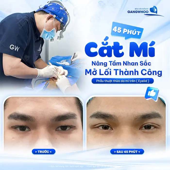 CẮT MÍ MẮT (EYELID) TỰ TIN THU HÚT MỌI ÁNH NHÌN – HOÀN THIỆN CỬA SỔ TÂM HỒN
