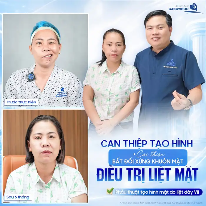 Điều trị liệt mặt (dây thần kinh số 7): Chẩn đoán và điều trị