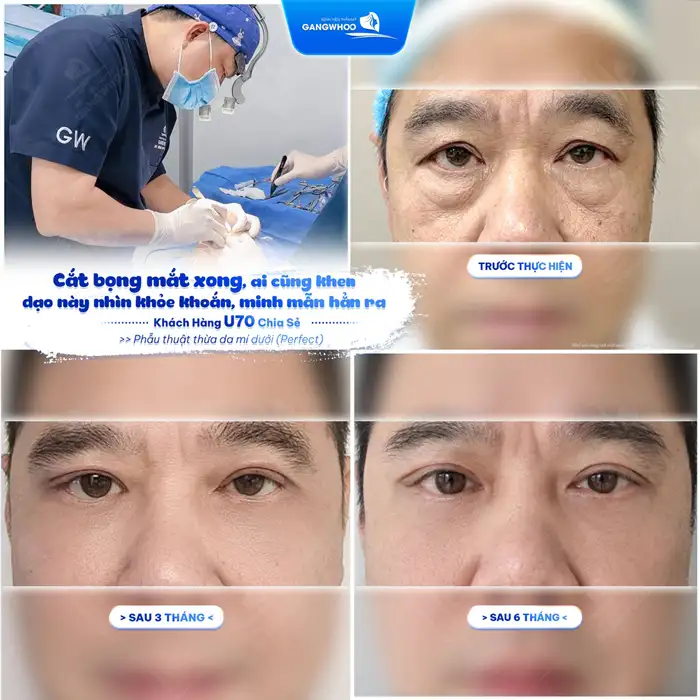 Cắt Da Thừa Mí Dưới + Lấy Mỡ XÓA BỎ TỰ TI VÌ ĐÔI MẮT THỪA MỠ, DƯ DA