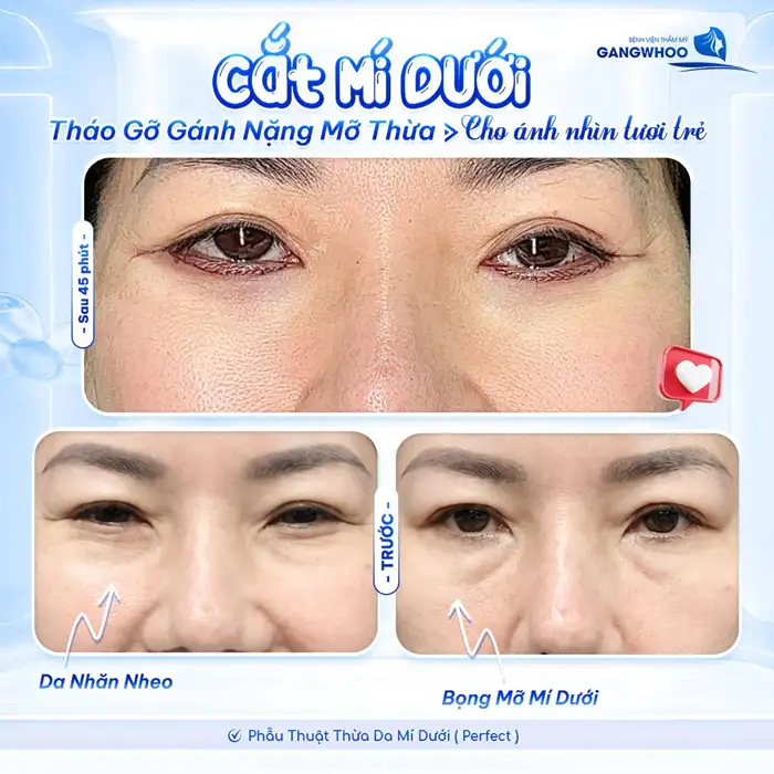 Cắt Da Thừa Mí Dưới Lấy Mỡ – Trẻ Hóa Vùng Mắt Toàn Diện