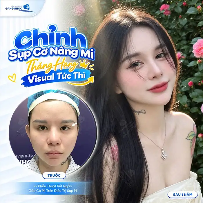 CHỈNH SỤP MÍ BẨM SINH VÀ PHƯƠNG PHÁP ĐIỀU TRỊ