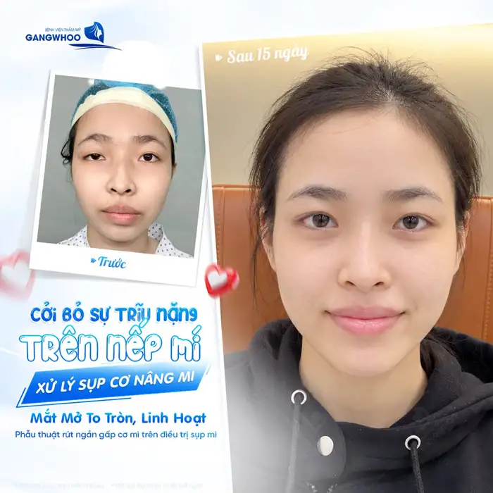 CHỈNH SỤP MÍ BẨM SINH VÀ PHƯƠNG PHÁP ĐIỀU TRỊ