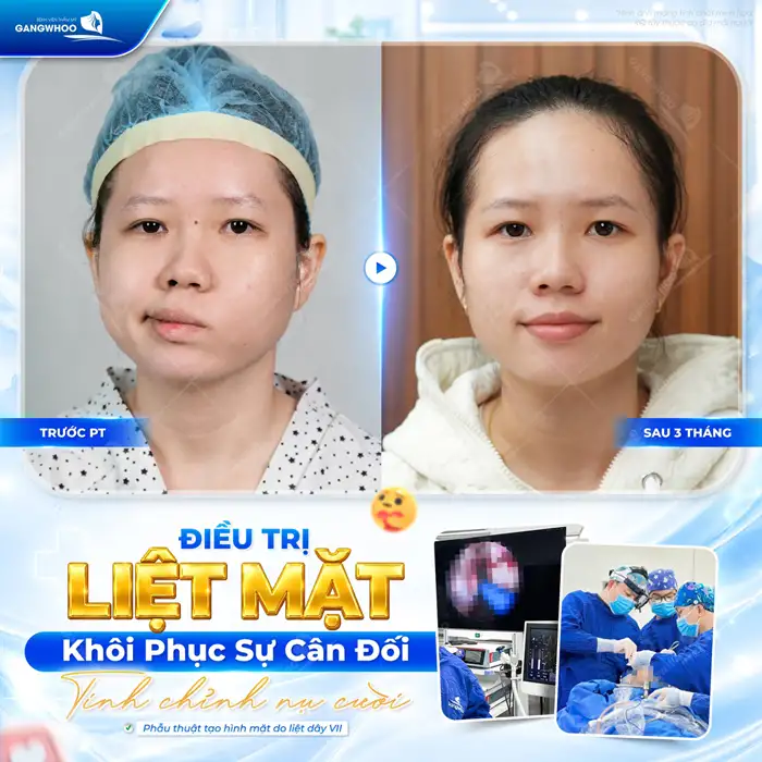 Điều trị liệt mặt (dây thần kinh số 7): Chẩn đoán và điều trị