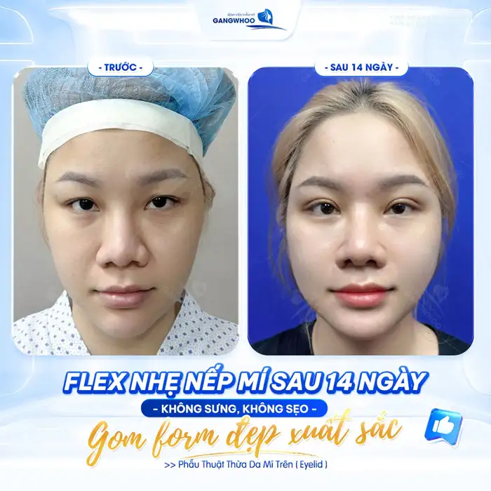 CẮT MÍ MẮT (EYELID) TỰ TIN THU HÚT MỌI ÁNH NHÌN – HOÀN THIỆN CỬA SỔ TÂM HỒN