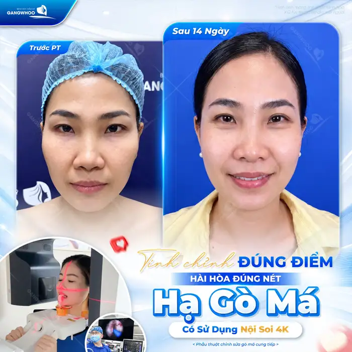 Độn thái dương khuôn mặt đầy đặn, nét ngài nở nang
