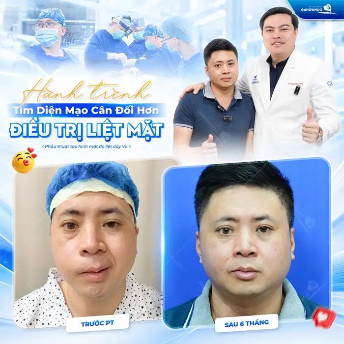 Điều trị liệt mặt (dây thần kinh số 7): Chẩn đoán và điều trị