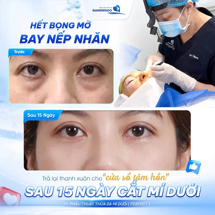 Cắt Da Thừa Mí Dưới + Lấy Mỡ XÓA BỎ TỰ TI VÌ ĐÔI MẮT THỪA MỠ, DƯ DA