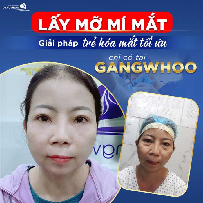 giải pháp trẻ hóa mắt tối ưu tại Gangwhoo