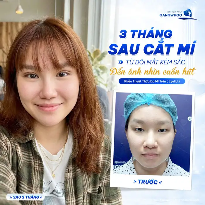 CẮT MÍ MẮT (EYELID) TỰ TIN THU HÚT MỌI ÁNH NHÌN – HOÀN THIỆN CỬA SỔ TÂM HỒN