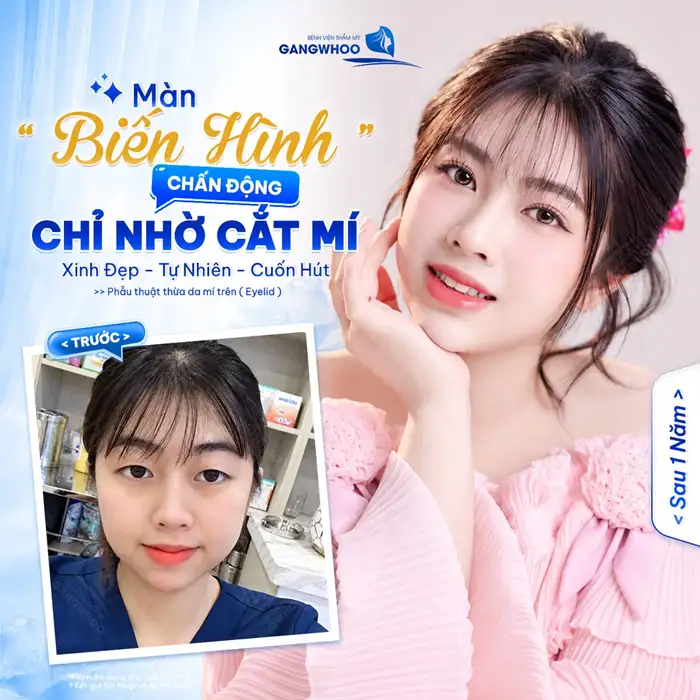 Cắt Mí Mắt Eyelid – Thay Đổi Nếp Mí Giúp Đôi Mắt Trở Nên Hài Hòa