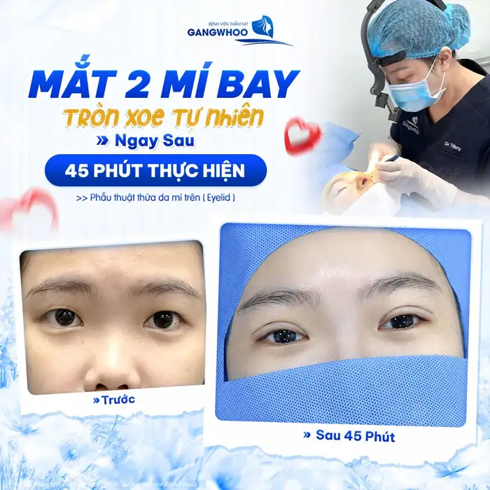 CẮT MÍ MẮT (EYELID) TỰ TIN THU HÚT MỌI ÁNH NHÌN – HOÀN THIỆN CỬA SỔ TÂM HỒN