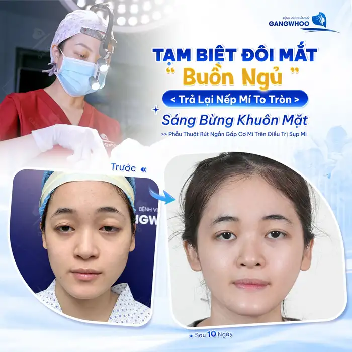 Chỉnh Sụp Mí Bẩm Sinh – Cải Thiện Dáng Mí Và Mở Rộng Tầm Nhìn