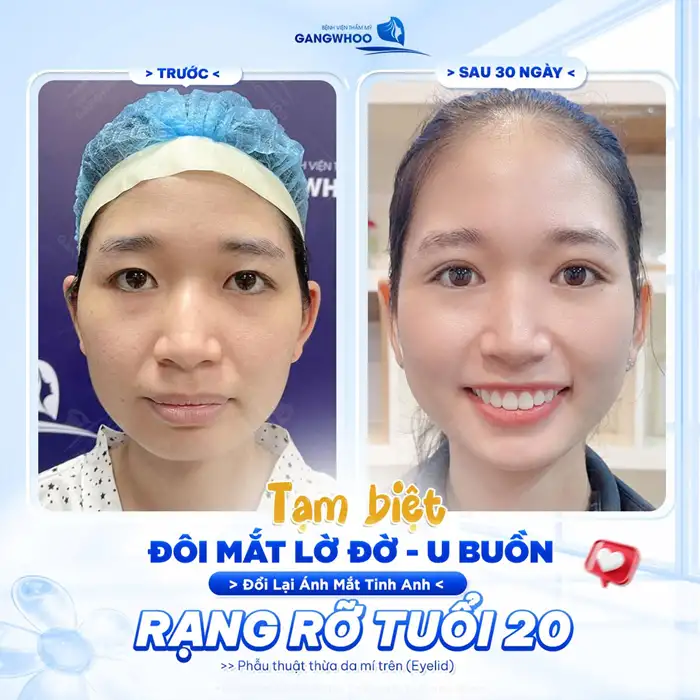 CẮT MÍ MẮT (EYELID) TỰ TIN THU HÚT MỌI ÁNH NHÌN – HOÀN THIỆN CỬA SỔ TÂM HỒN