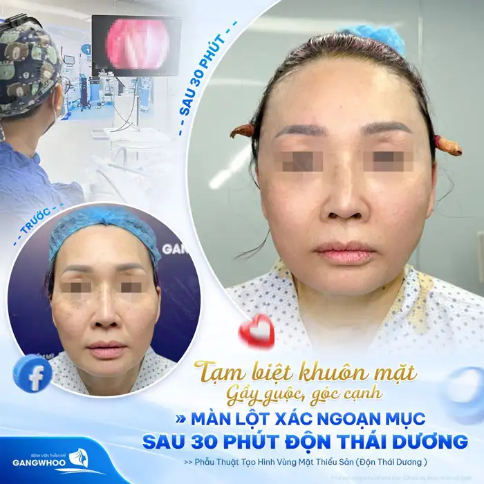 Độn thái dương khuôn mặt đầy đặn, nét ngài nở nang