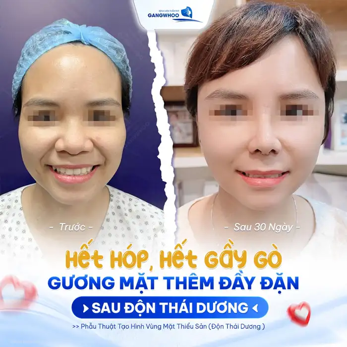 Độn thái dương khuôn mặt đầy đặn, nét ngài nở nang