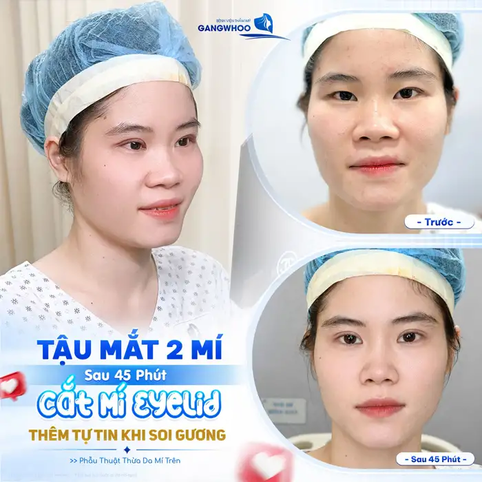 Cắt Mí Mắt Eyelid – Thay Đổi Nếp Mí Giúp Đôi Mắt Trở Nên Hài Hòa