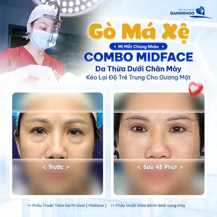 Nâng cung chân mày cải thiện tình trạng sụp mí, kiến tạo lại đôi mắt hài hòa