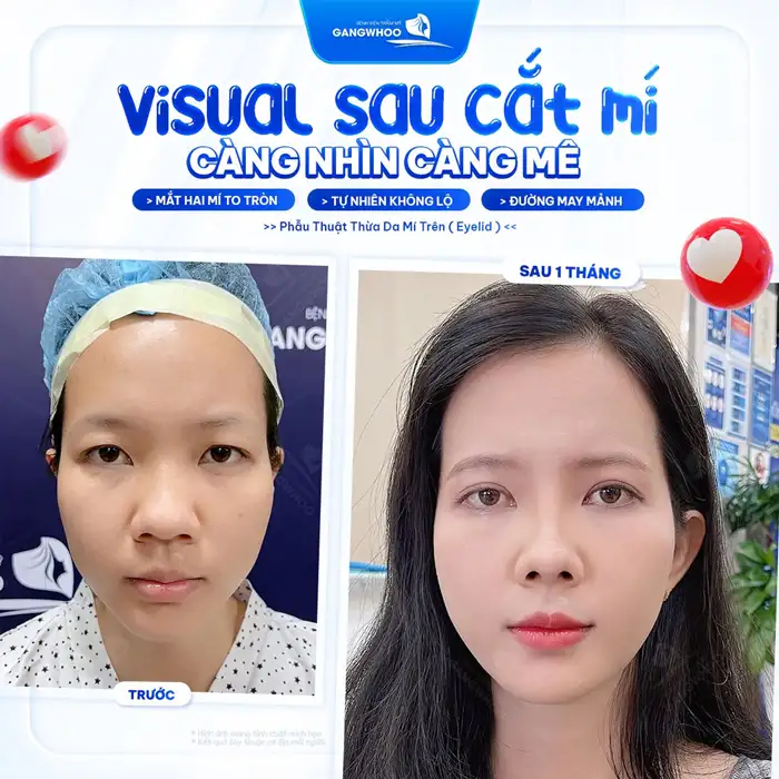 CẮT MÍ MẮT (EYELID) TỰ TIN THU HÚT MỌI ÁNH NHÌN – HOÀN THIỆN CỬA SỔ TÂM HỒN