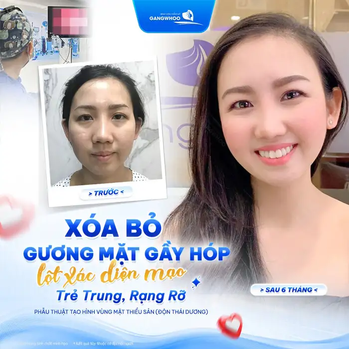 Độn thái dương khuôn mặt đầy đặn, nét ngài nở nang