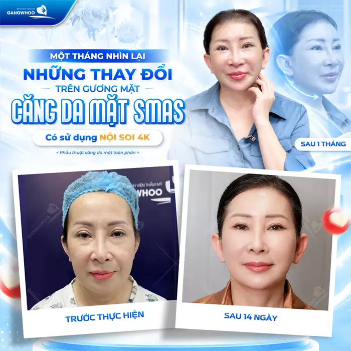 Căng Da Mặt Không Phẫu Thuật An Toàn, Hiệu Quả Không Lo Xâm Lấn