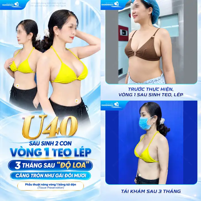 Nâng ngực đường nách – Phù hợp cho những đối tượng nào?