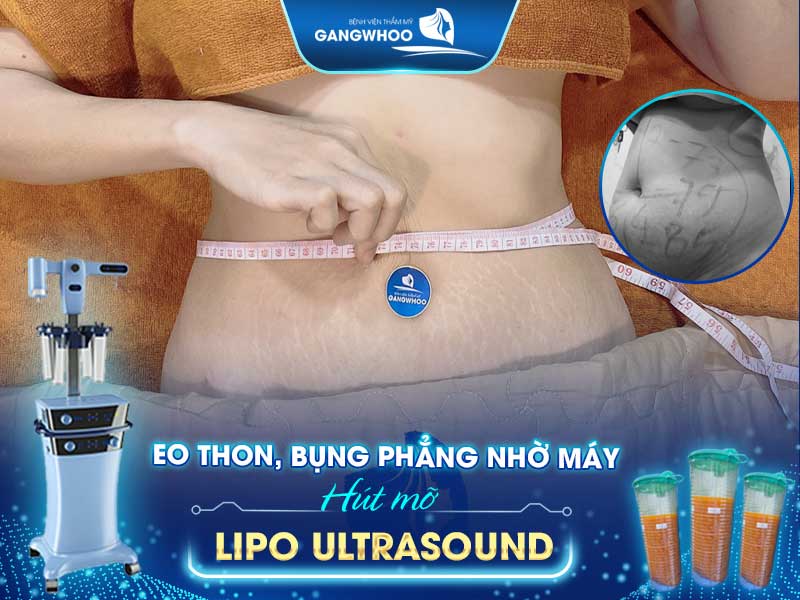 Eo thon, bụng phẵng nhờ Lipo Ultrasound