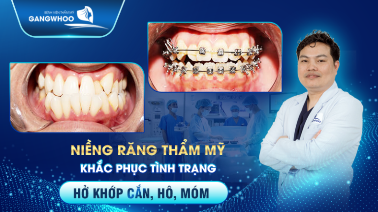 NIỀNG RĂNG (CHỈNH NHA) LÀ GÌ ? PHƯƠNG PHÁP NIỀNG RĂNG HIỆN ĐẠI NHẤT