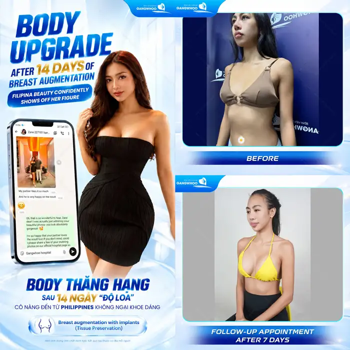 Nâng ngực loại nào tốt? Túi độn ngực có thời hạn bao lâu?