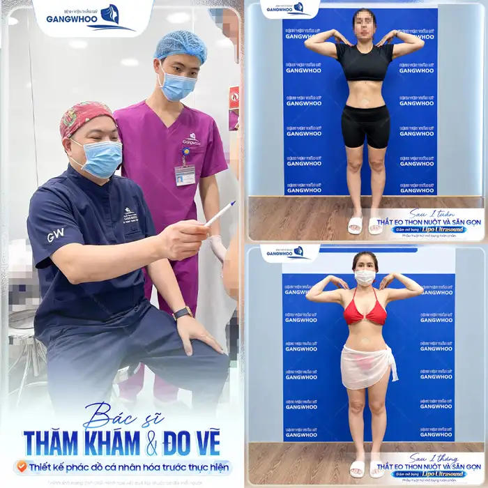 Tuân Thủ Quy Trình Hút Mỡ Bụng Sở Hữu Eo Thon Trong Tích Tắc