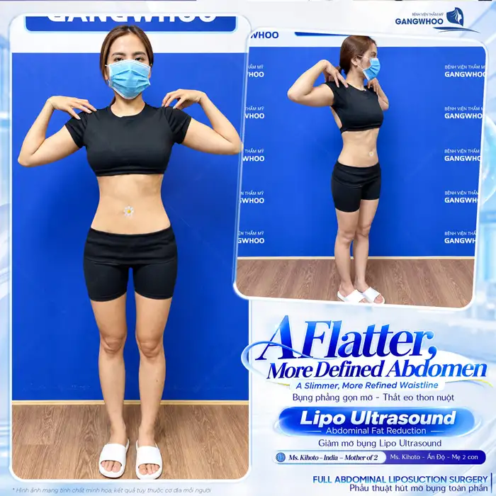 Tuân Thủ Quy Trình Hút Mỡ Bụng Sở Hữu Eo Thon Trong Tích Tắc