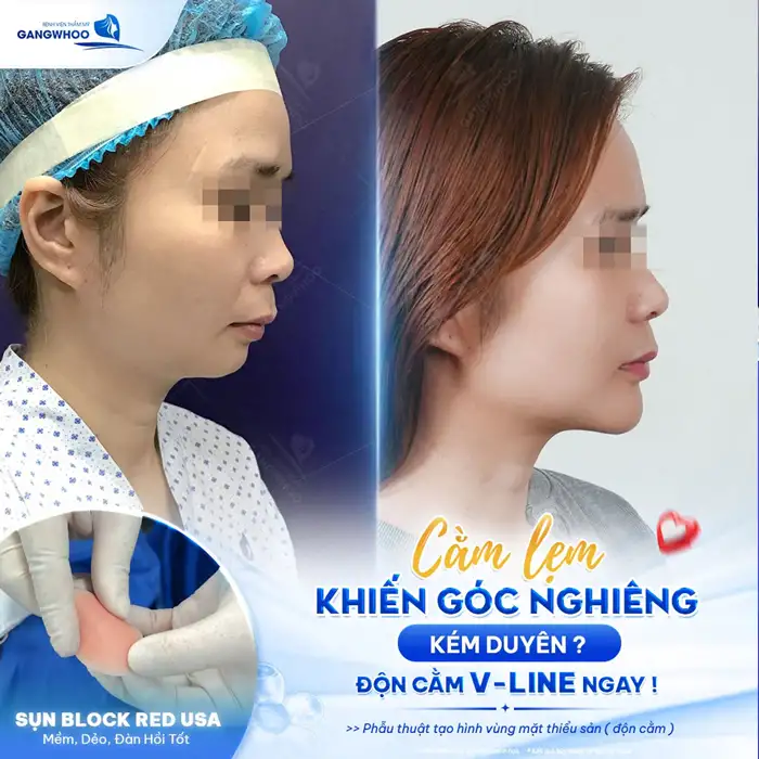 Độn cằm – Xu hướng làm đẹp cho khuôn mặt chuẩn V-Line