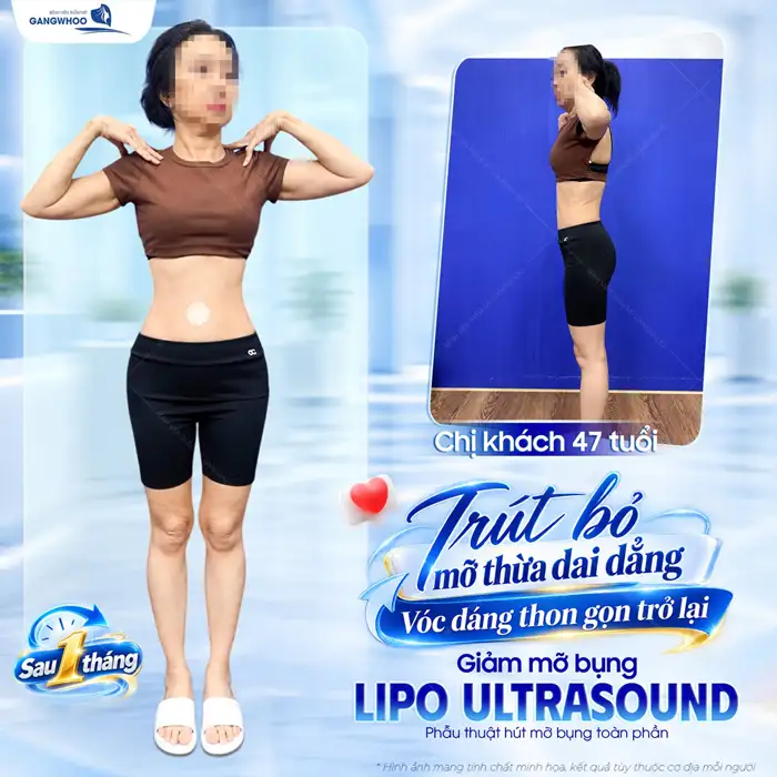 Công Nghệ Hút Mỡ Bụng Chuẩn Hàn Thoát Vòng Eo “Bánh Mì”