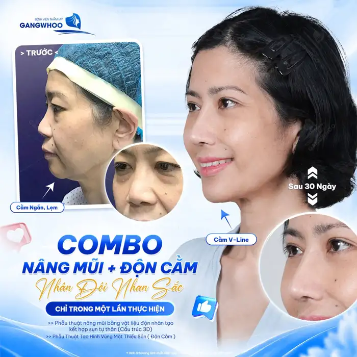 Độn cằm – Xu hướng làm đẹp cho khuôn mặt chuẩn V-Line